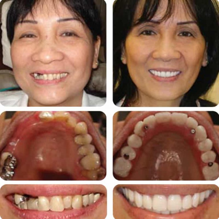 Dental Implants Austin, TX Bridgeview Dental