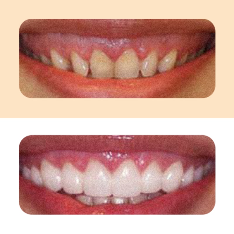 before and after gummy smile