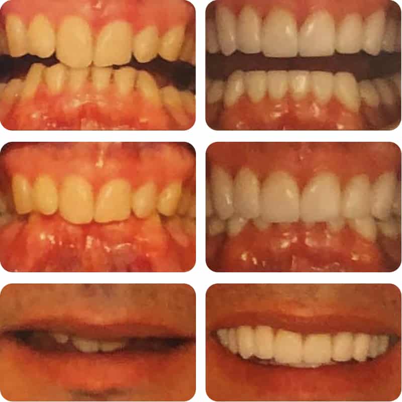 before and after smile makeover